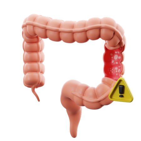 Ulcerative colitis  3D Icon