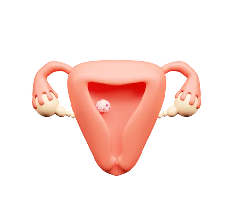Uterus Cancer  3D Icon