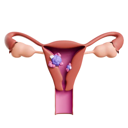 Uterus Cancer  3D Icon