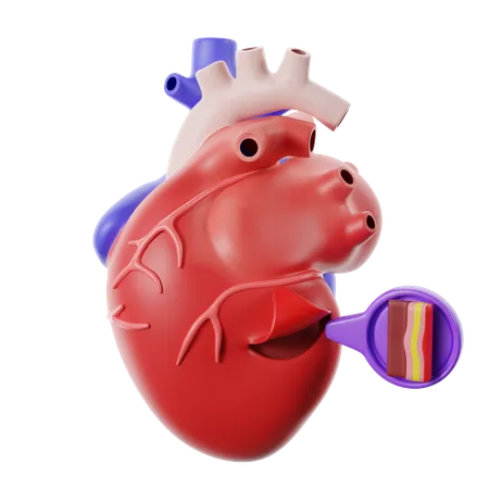 Der Herzkrankheit Perikarditis  3D Icon