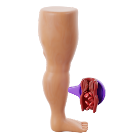 Der Herzkrankheit Thrombose  3D Icon