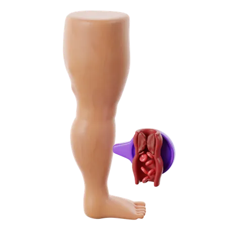 Der Herzkrankheit Thrombose  3D Icon